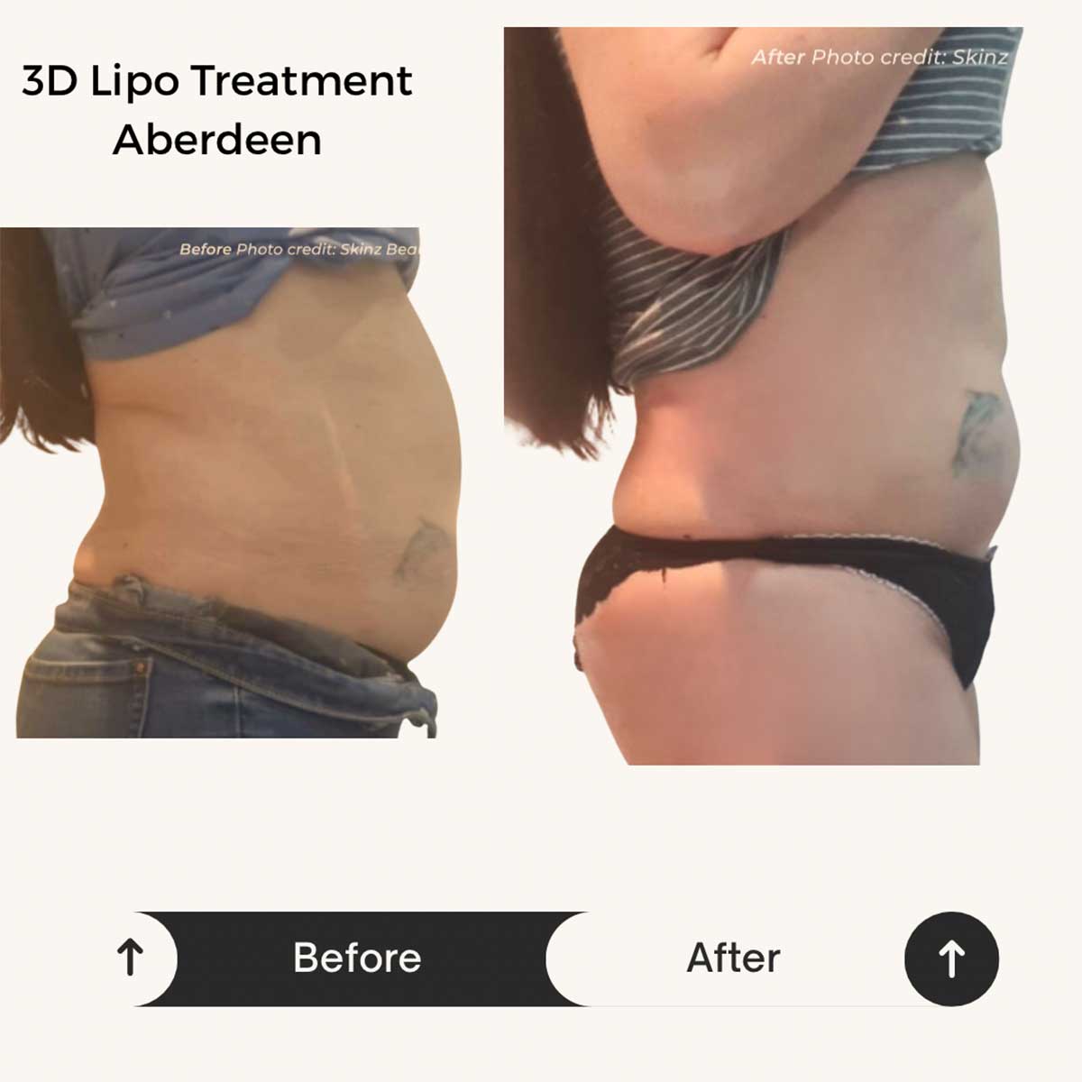 3D Lipo before and after results in Aberdeen