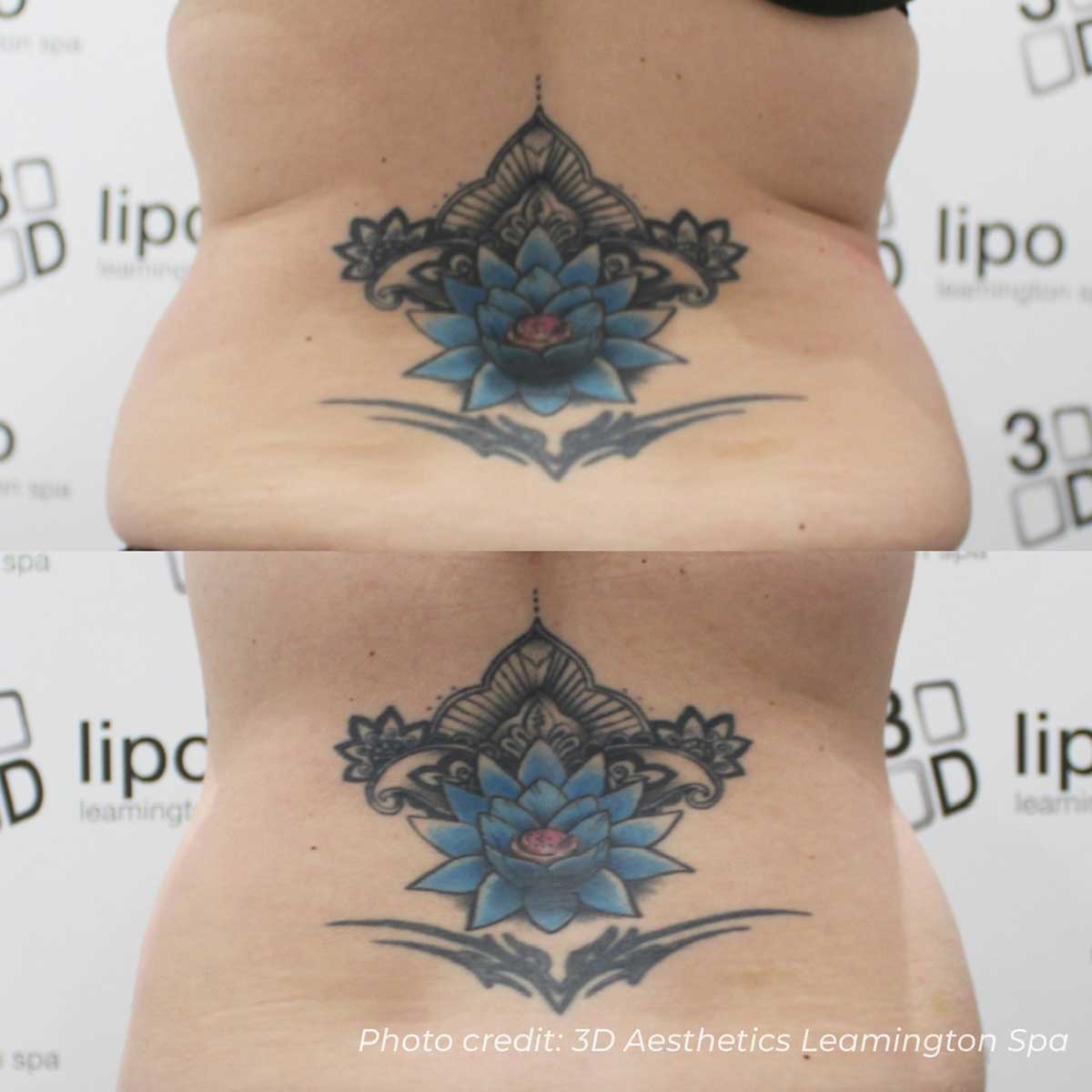 3D Lipo fat reduction before and after