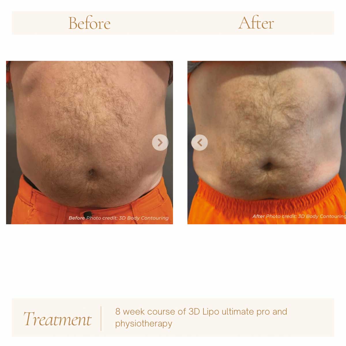 3D Lipo body contouring before and after